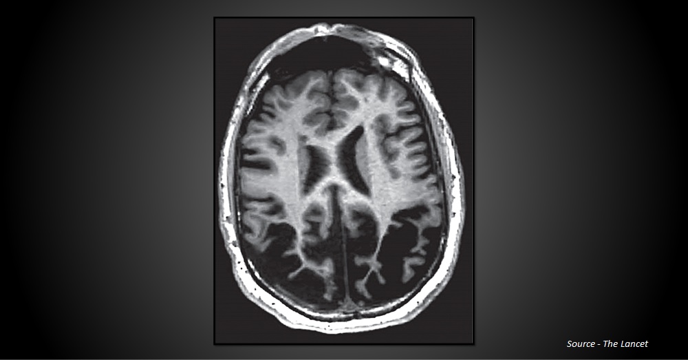 Infer The MRI Finding