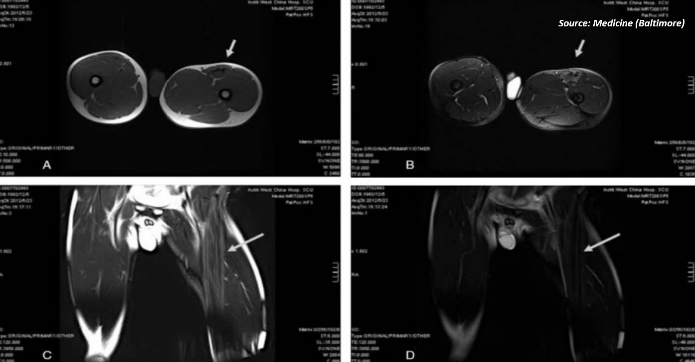 Identify the Reason Behind Restricted Hip Joint Movement