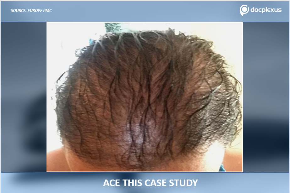 Diagnose This Case of Hair Loss