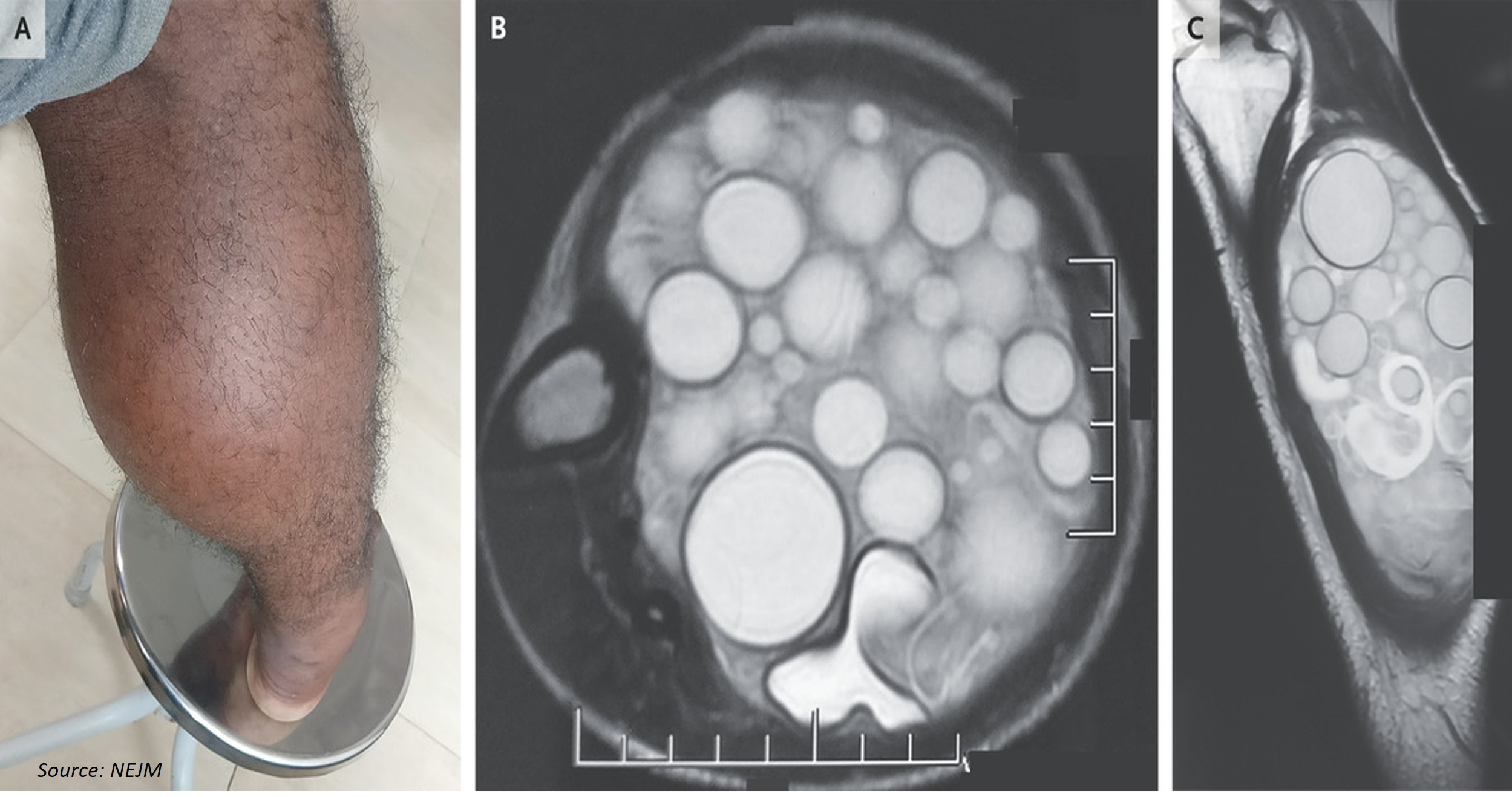 A Case of Cysts in the Leg