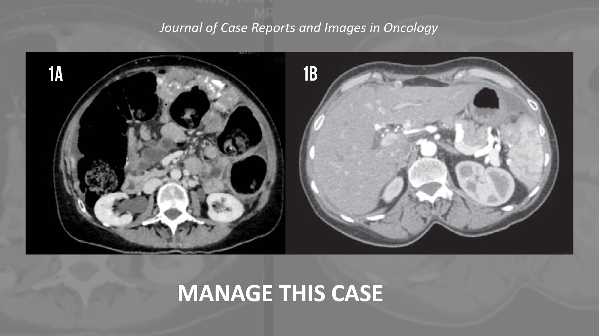 Manage This Case of Low-grade Serous Carcinoma