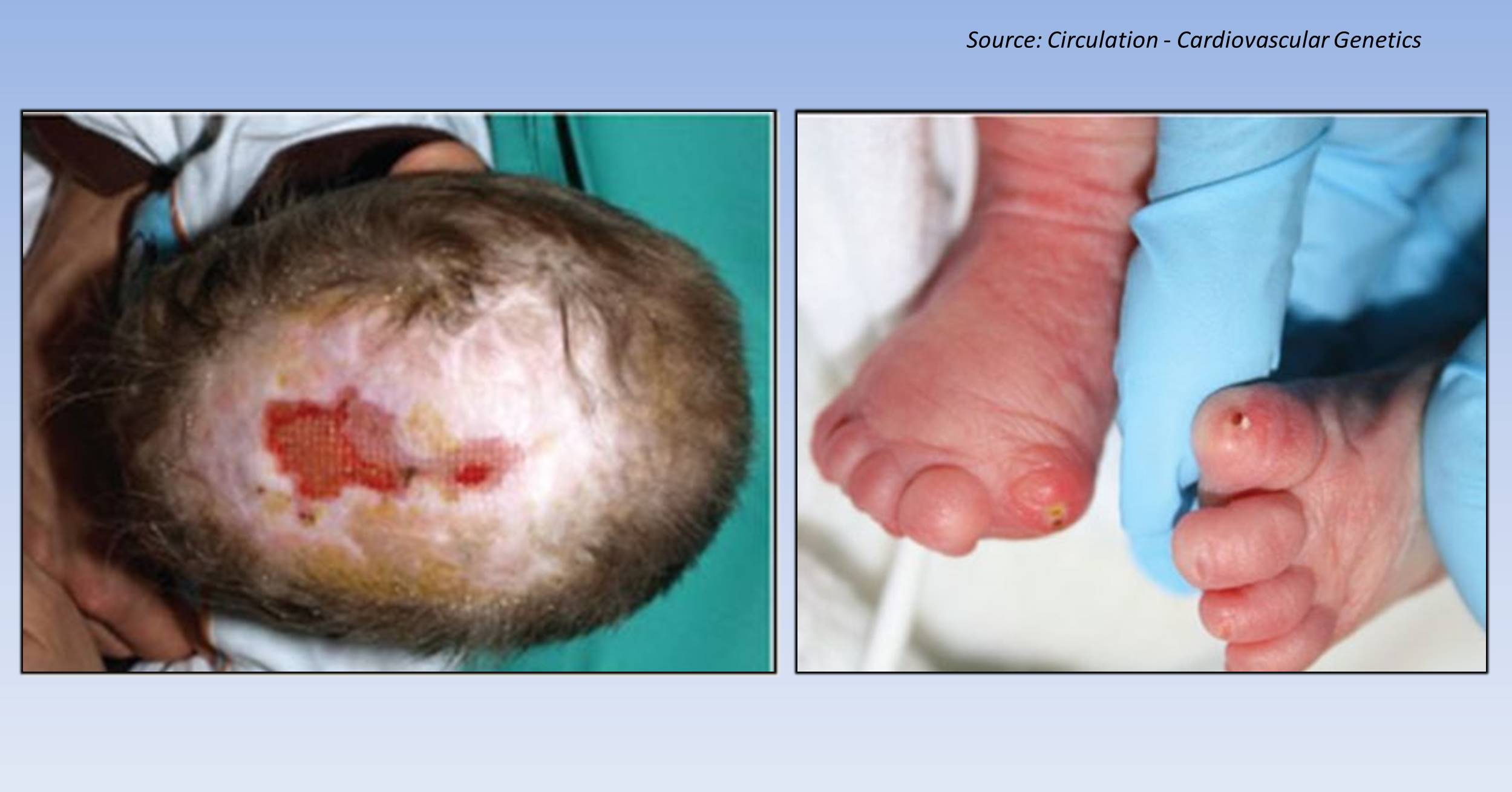 Aplasia Cutis Congenita – A Group of Rare Disorders