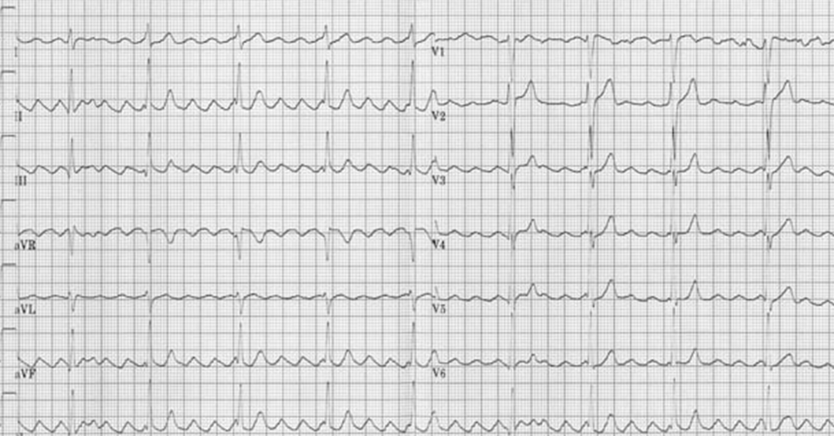 What Does This ECG Reveal?
