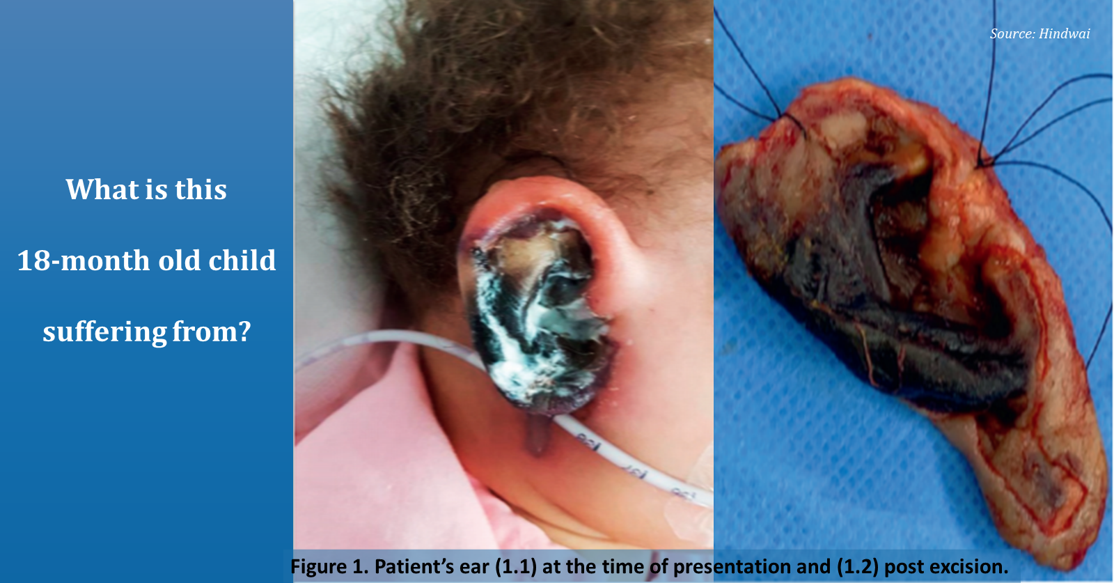 A Rare Case of Gangrenous Discoloration of the Right Auricle