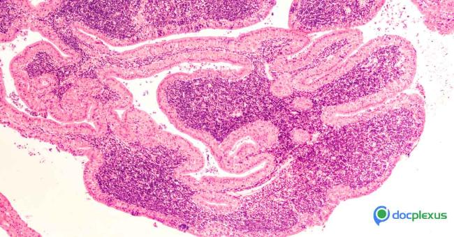 Assessing Tumor Deposits in Salivary Gland Tumors