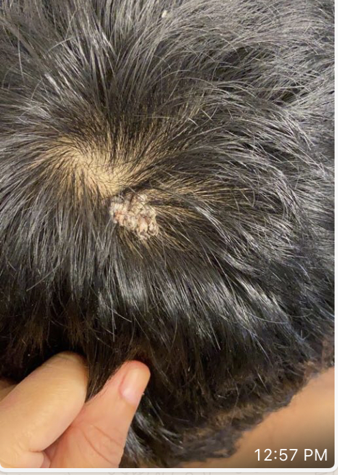 What is the Diagnosis of This Scalp Lesion and What Would Be the Appropriate Management?