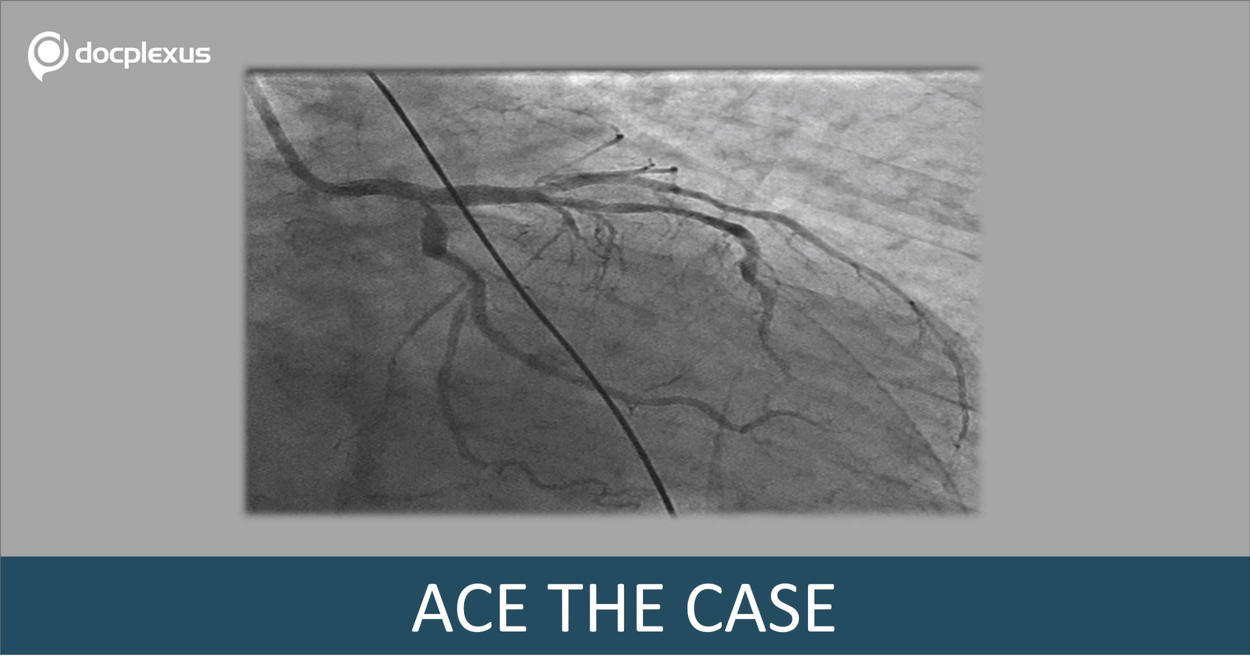 Rare Clinical Case of Acute Coronary Syndrome