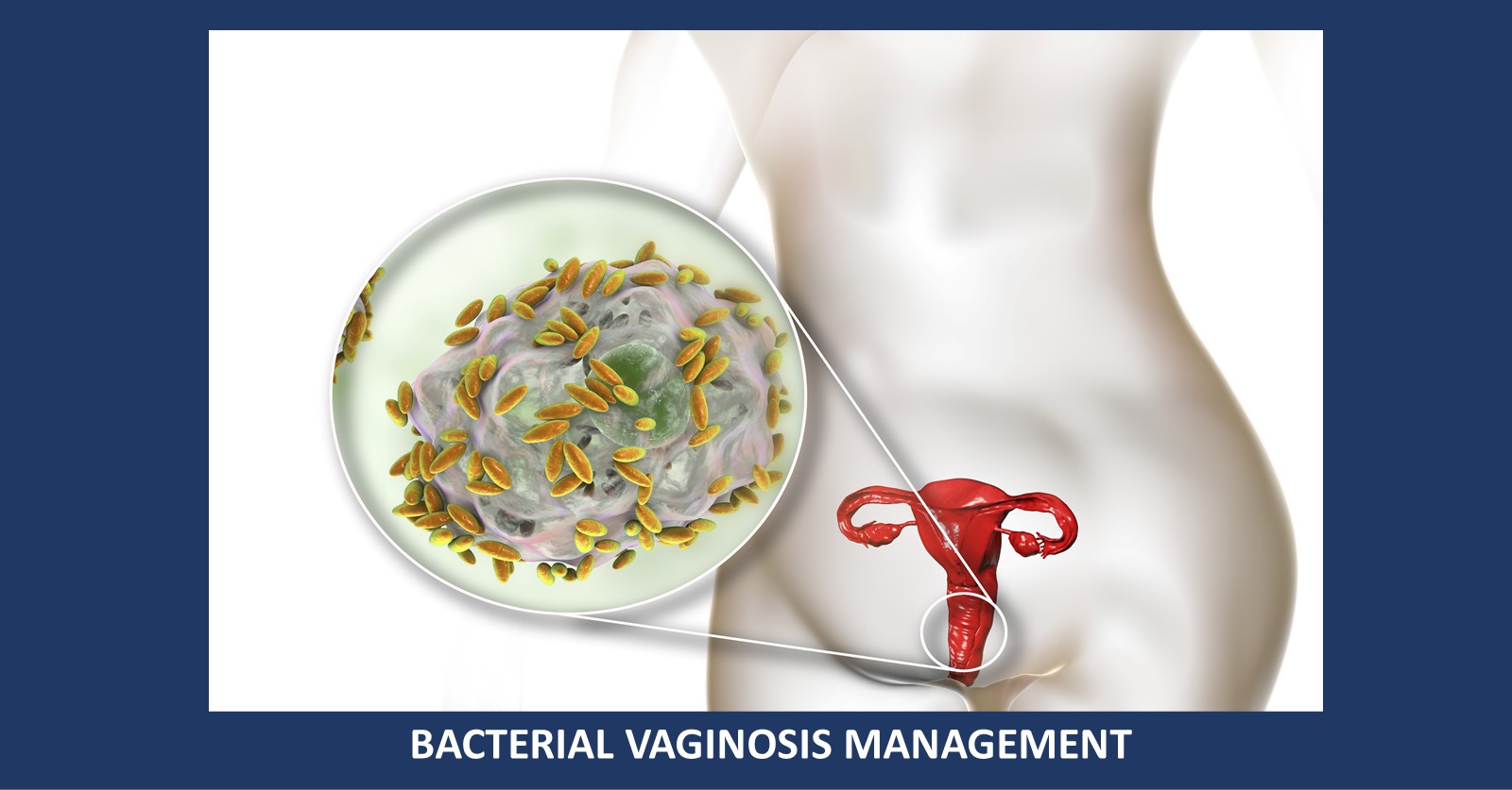 Bacterial Vaginosis: Treatment and Management Guidelines 2021
