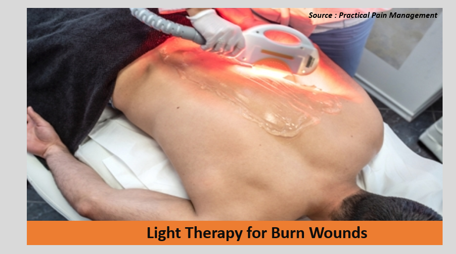 Photobiomodulation Therapy – An Effective Burn Wound Management