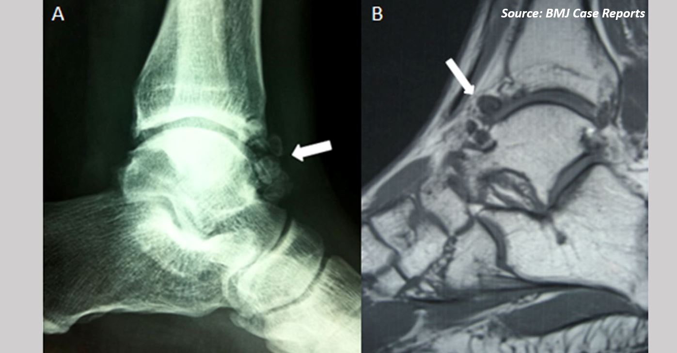 Identify the Reason Behind Pain in the Left Ankle