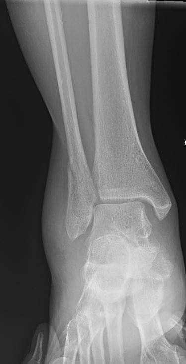 Ankle Injury