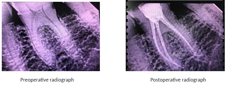 Case Of Pain In Tooth On Biting