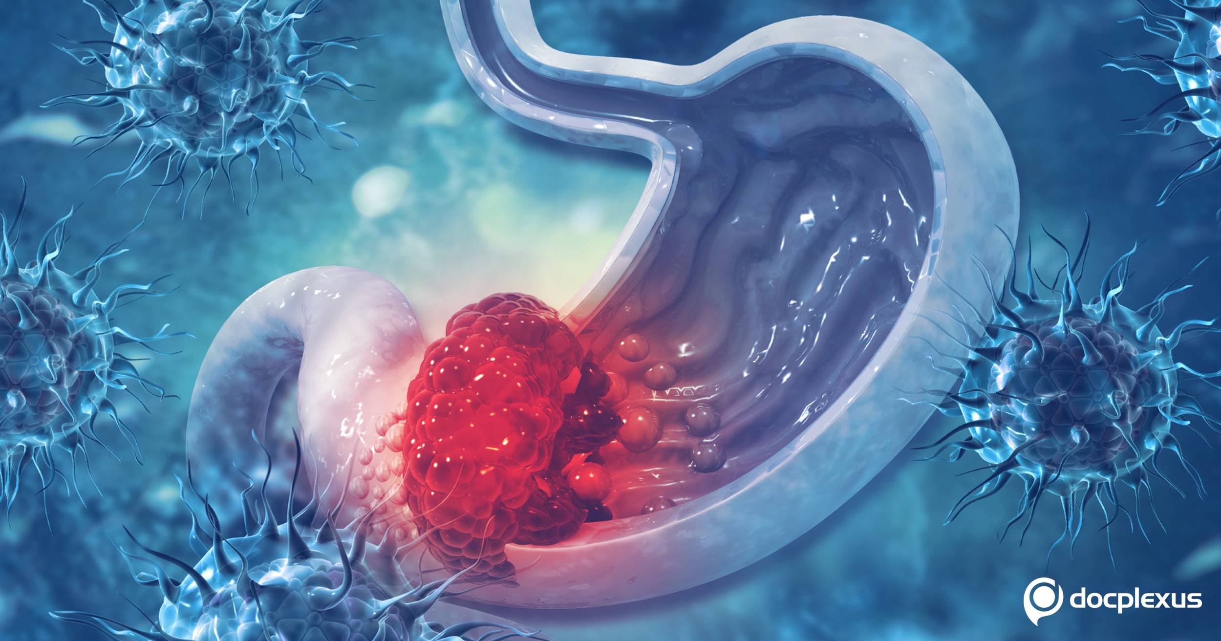Removal of a Woman’s Stomach to Treat Aggressive Tumor