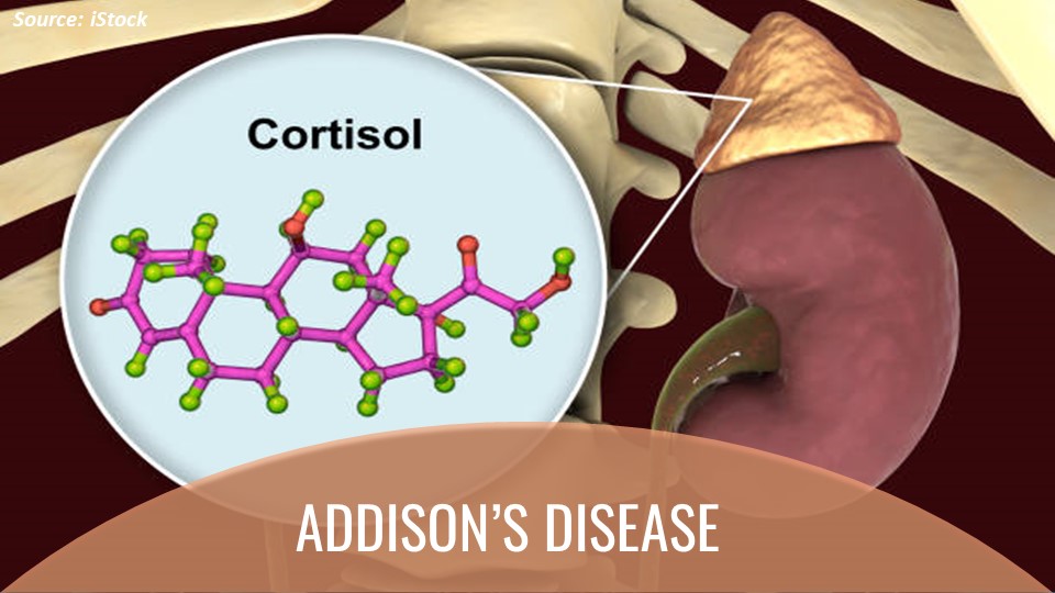 How Well Do You Know Addison’s Disease?