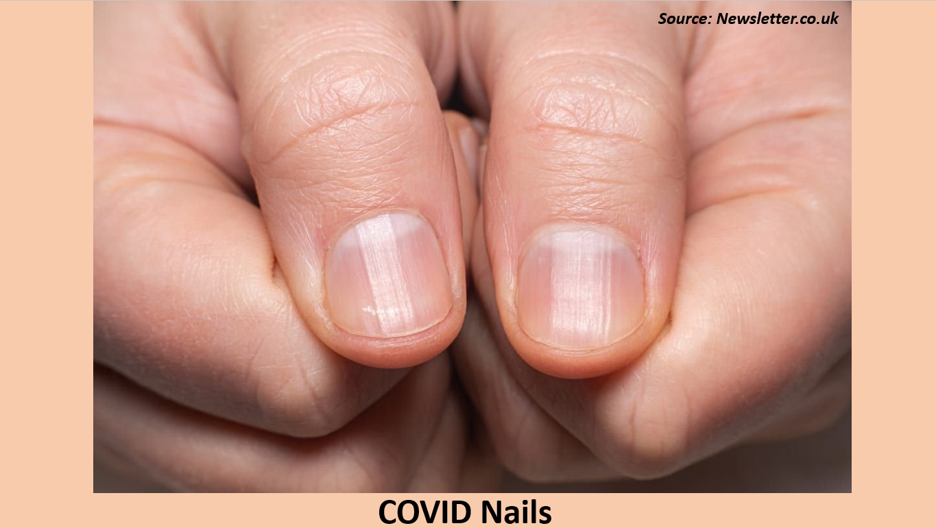 COVID Nails – A Post-COVID Symptom