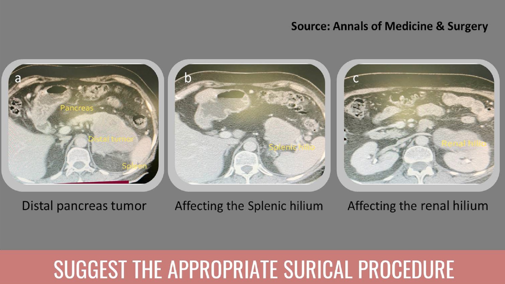 52-year-old Female Diagnosed With Frantz Tumor – Suggest a Surgical Procedure