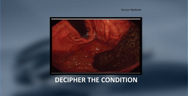 Which Condition does this Endoscopic Image Indicate?