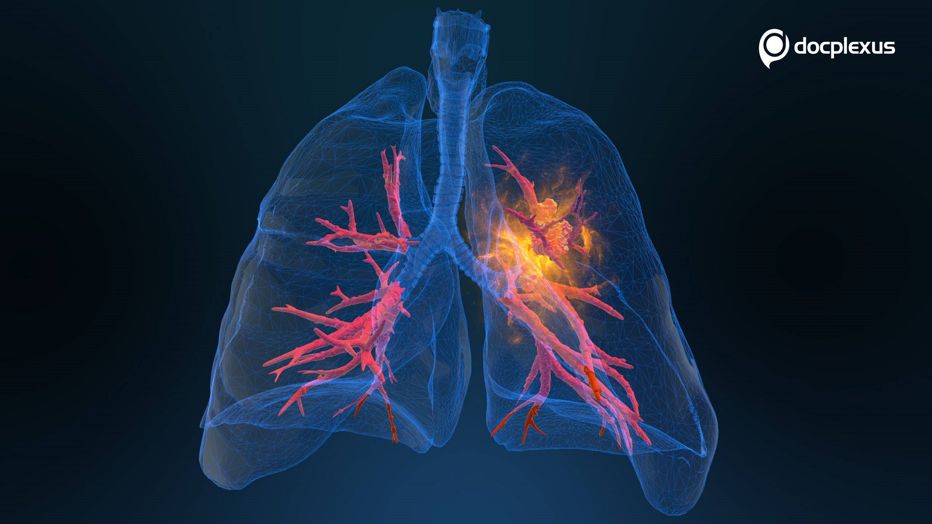Extensive Use of HRCTs During the COVID-19 Pandemic Aid in the Early Diagnosis of Lung Cancer