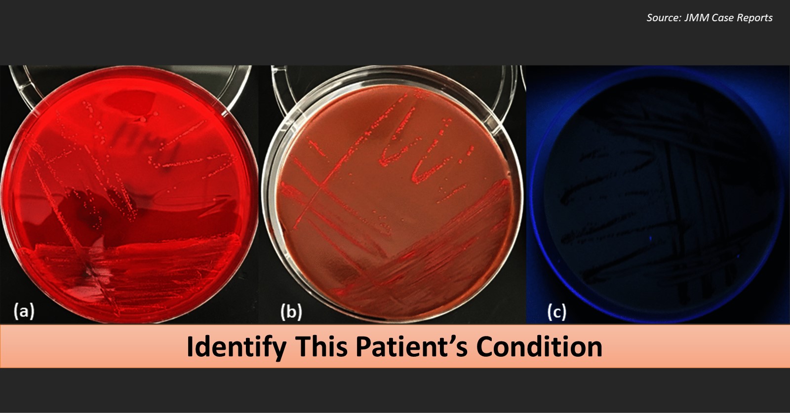 Case of a Patient with Pain Due to Osteoarthritis - Diagnose the Condition !