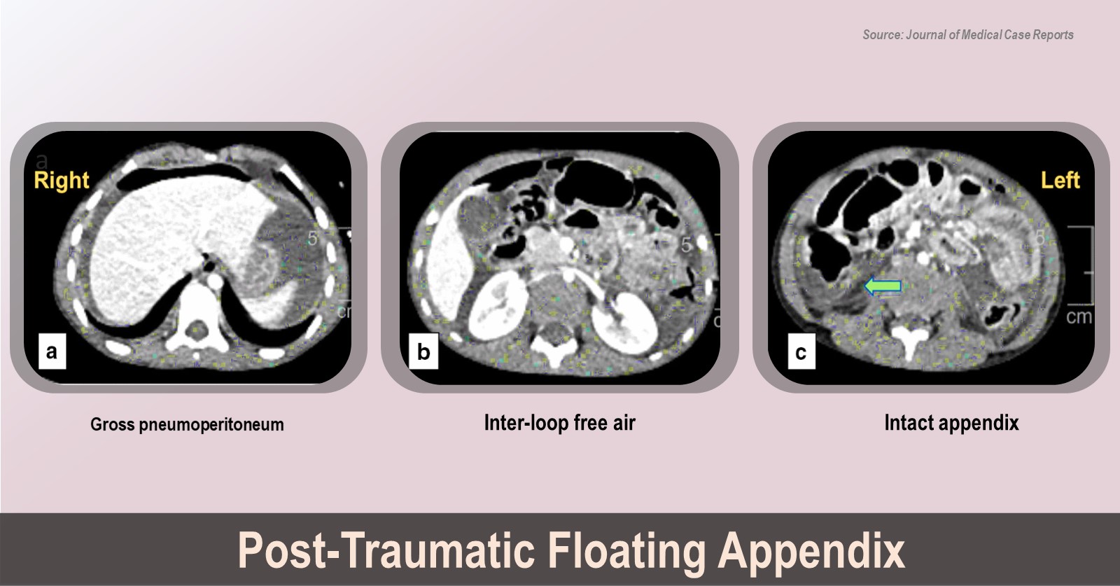 Post-traumatic Amputation of the Appendix