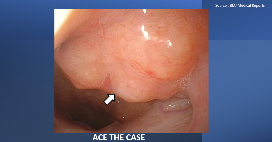 An Abnormal Shadow on the Chest Radiograph of a Woman – What’s Your Diagnosis?