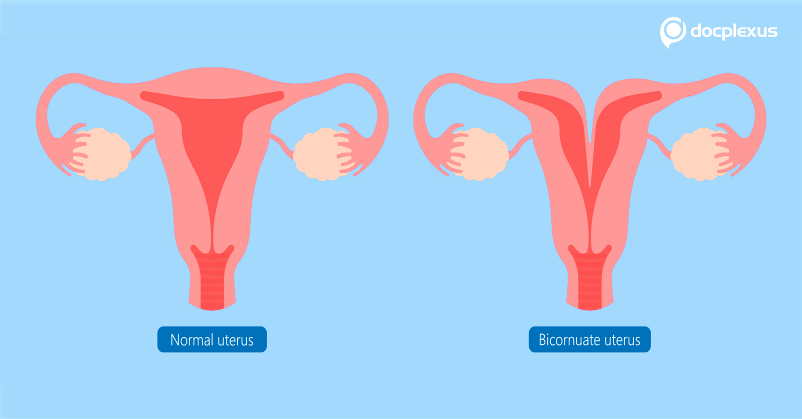 Uterus Didelphys: A Rare Mullerian Duct Anomaly