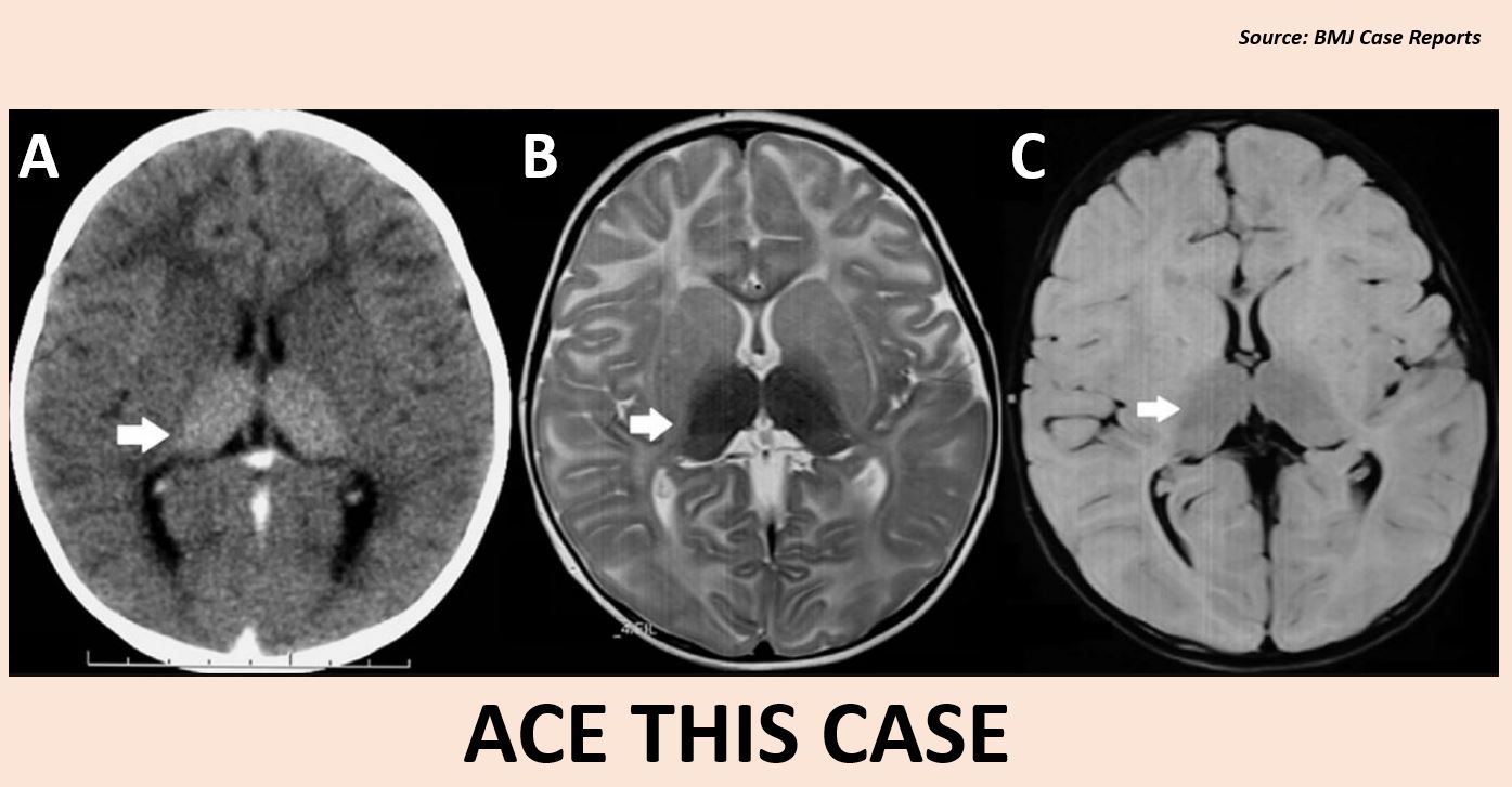 A Boy with Recurrent Generalized Seizures - What’s Your Diagnosis?