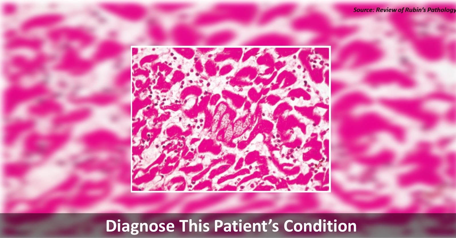 Case of a Female with Tachycardia