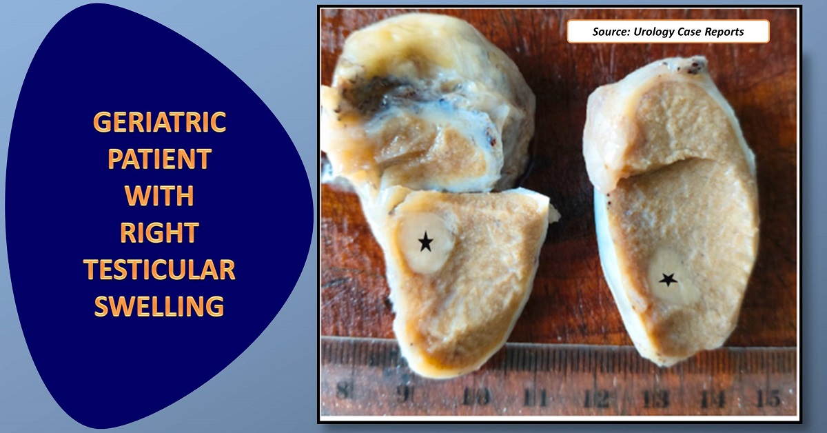 A Geriatric Patient with Painless Testicular Swelling