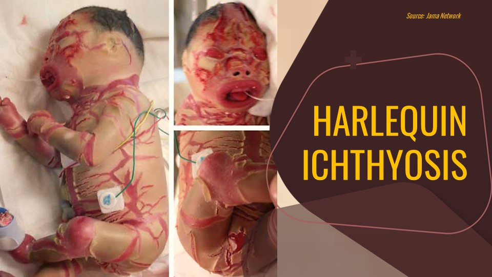 Harlequin Ichthyosis: A Rare Genetic Skin Disorder