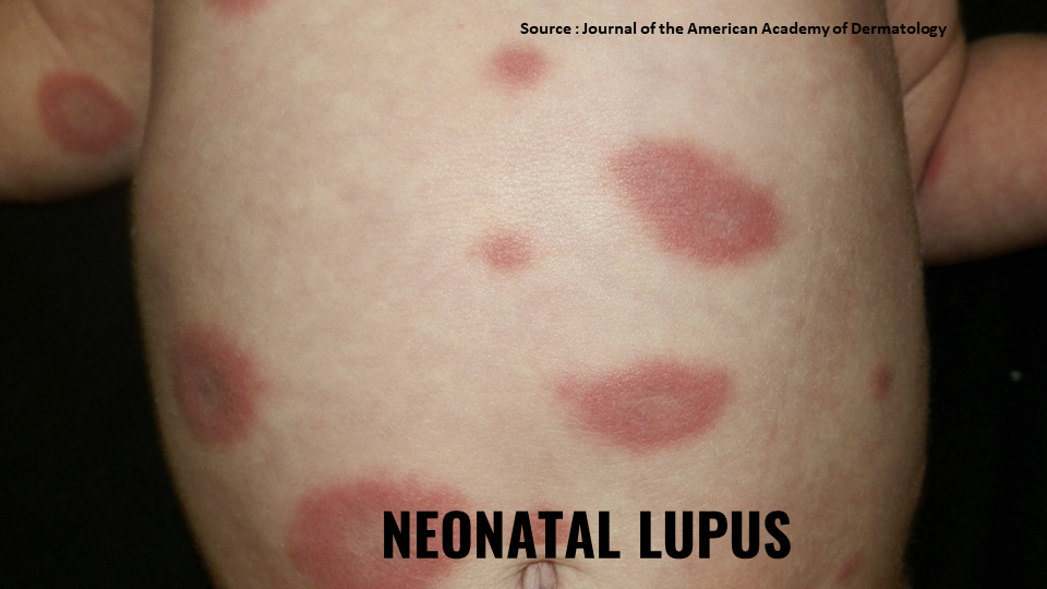 Neonatal Lupus – A Rare Autoimmune Disease