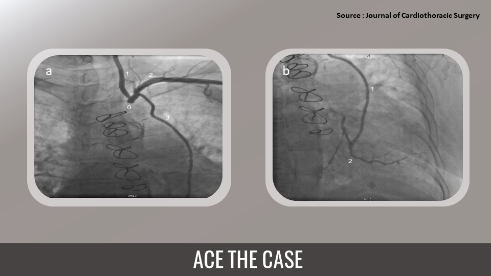 An Unusual Cause of Angina Post-CABG in a 71-Year-Old Woman – Can You Guess?