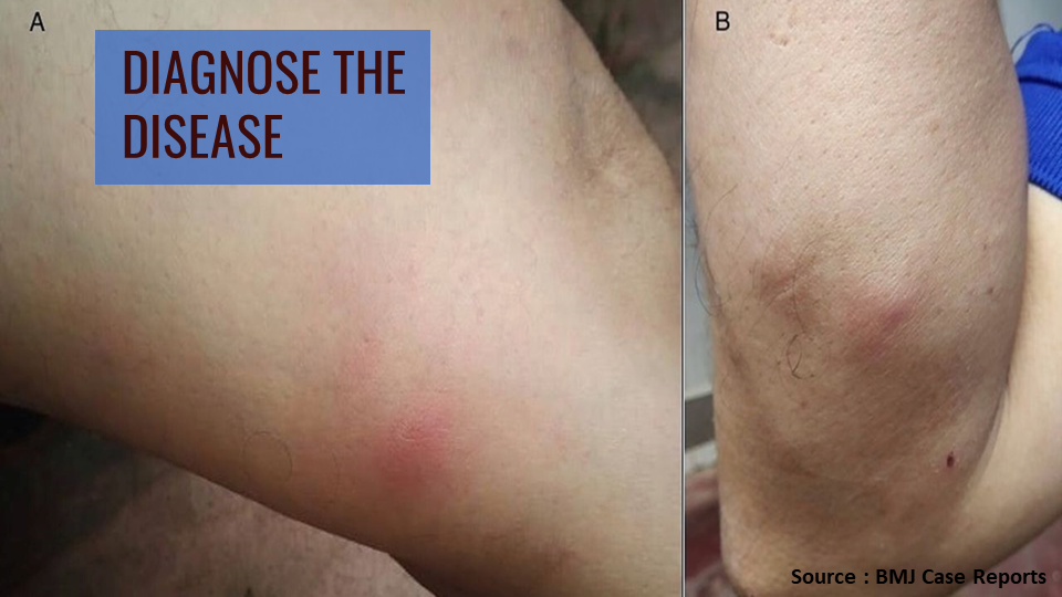 Case of a Diabetic Woman with Swelling Over Extremities