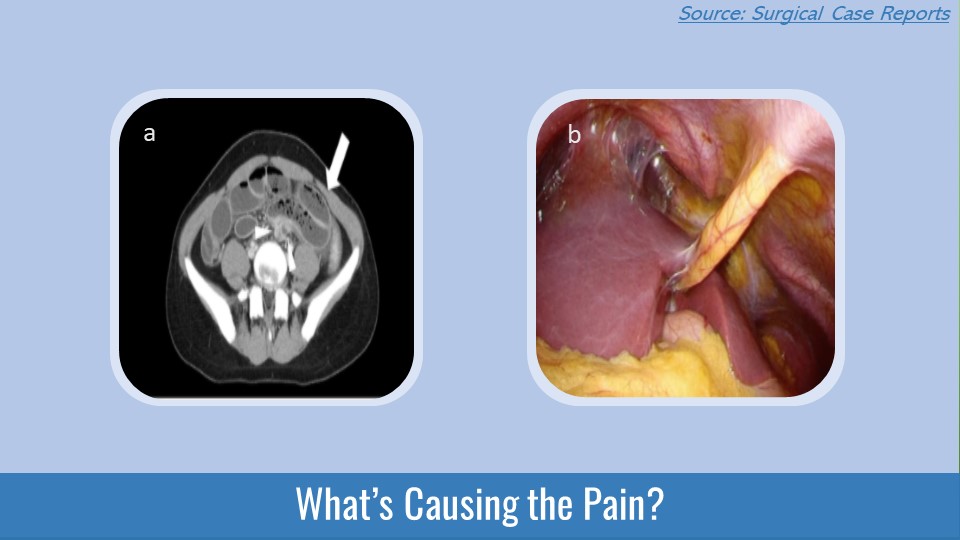 Relapsed Abdominal Pain with an Intrapelvic Abscess -  What’s Your Diagnosis?
