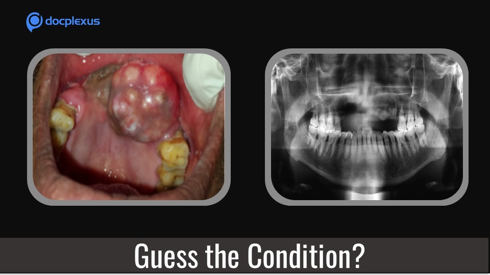 Swelling in the upper jaw – What’s your diagnosis?