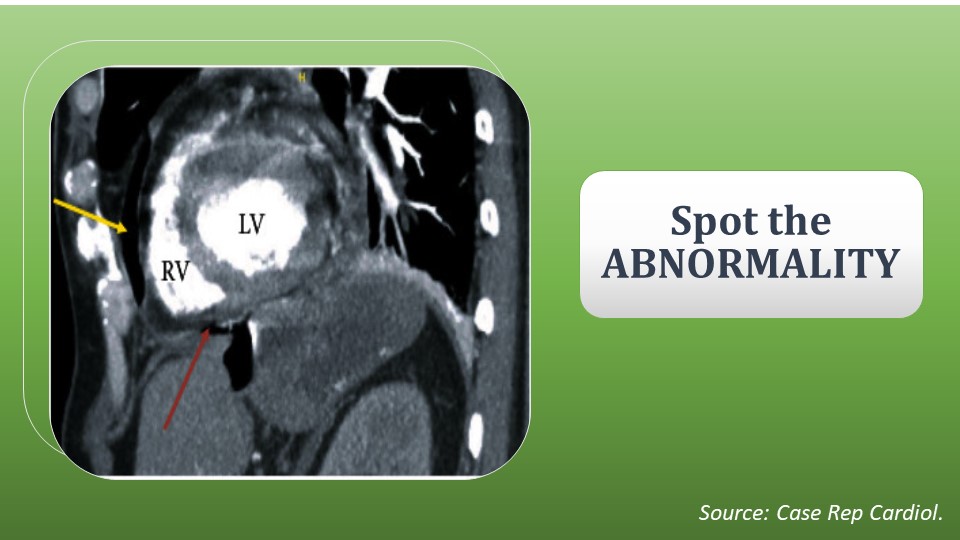 Detect and Diagnose the Reason Behind the Shoulder Pain