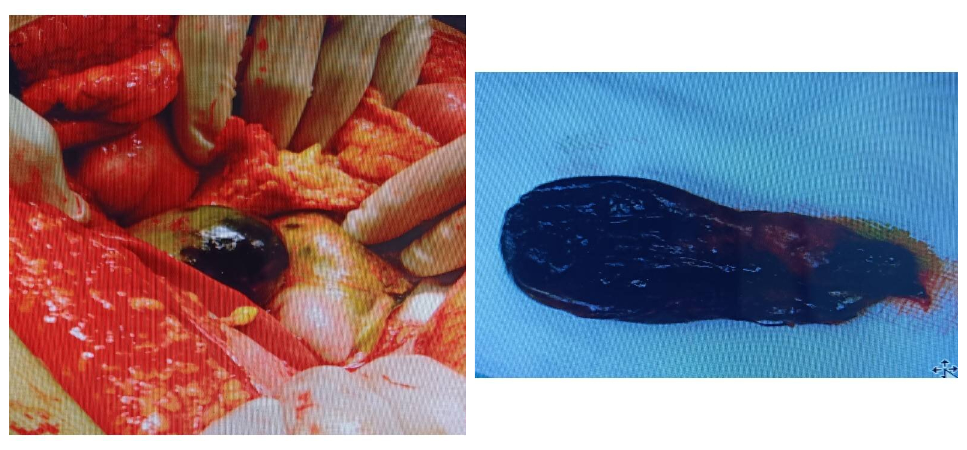 Isolated Gangrene of Gall Bladder Following Blunt Abdominal Trauma