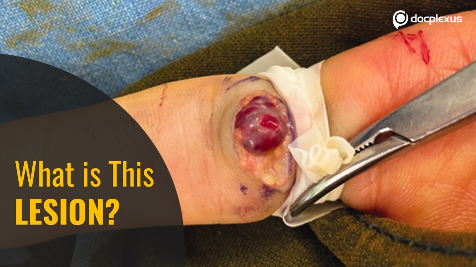 What is This Protrusive Mass?