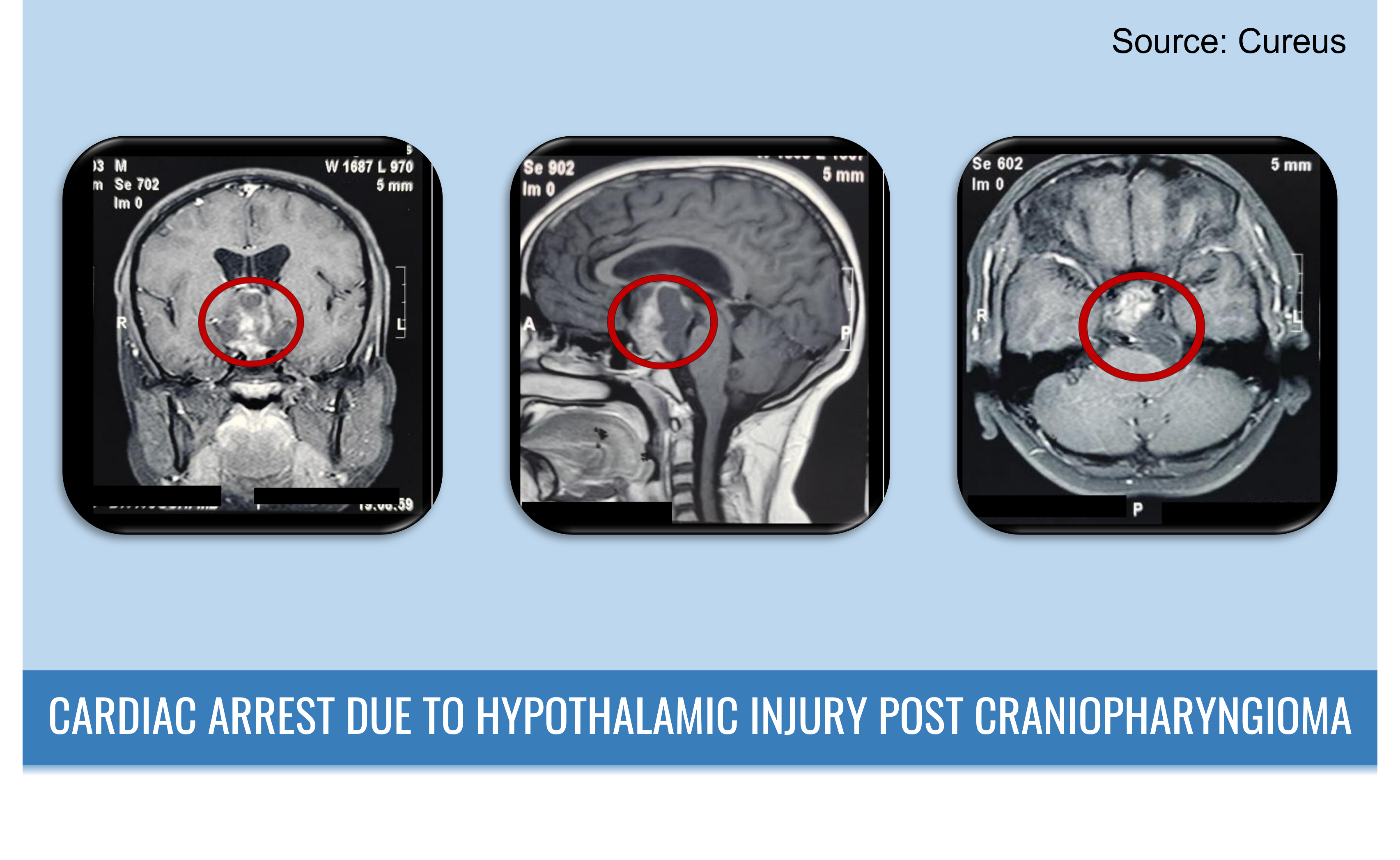 Identify the Reason Behind Hypothalamic Injury