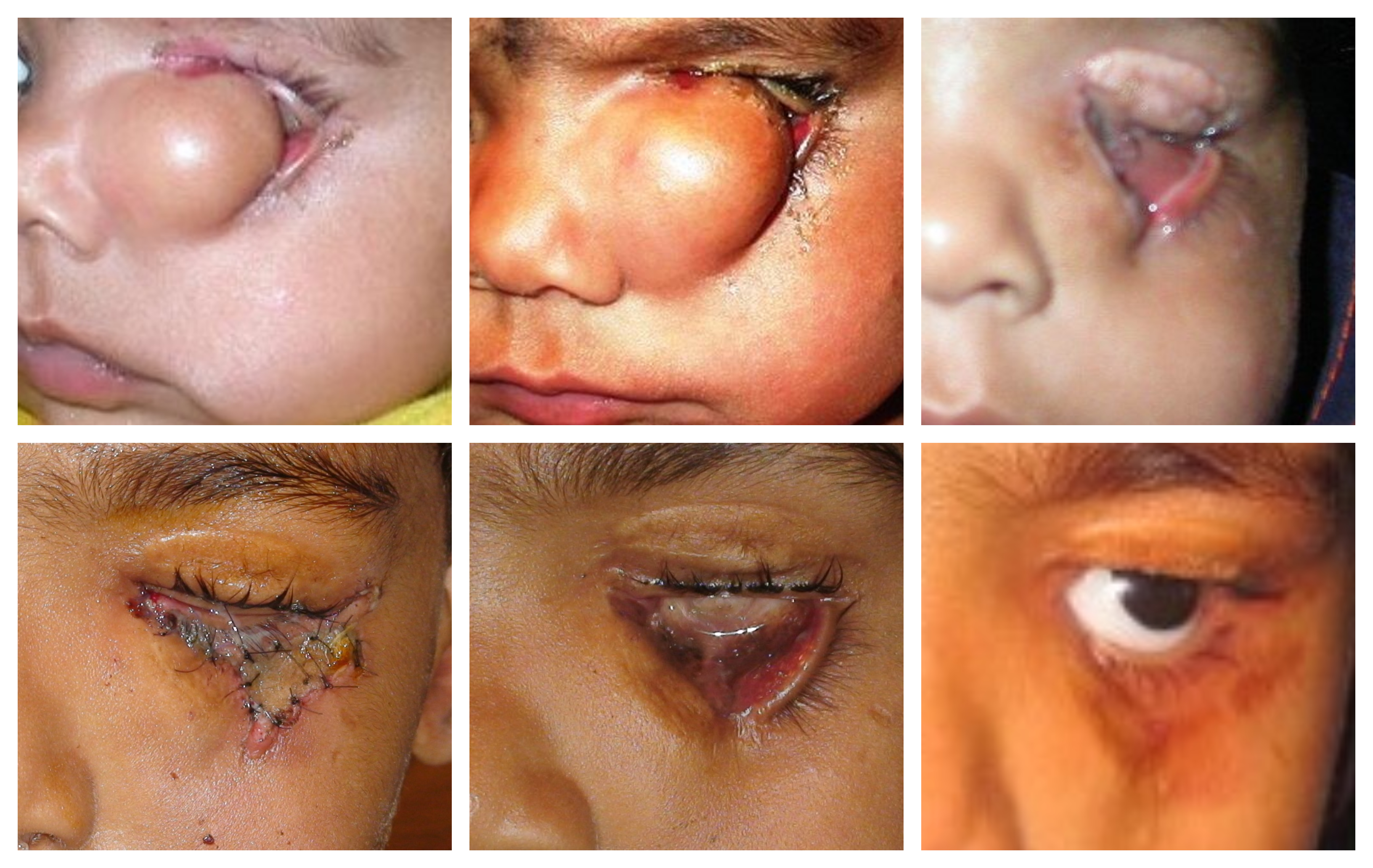 Congenital Cryptophthalmos Treated Successfully by Surgical Treatment