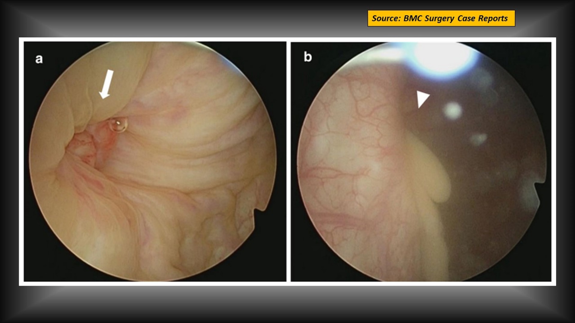 A Rare Complication of Laparoscopic Inguinal Hernioplasty
