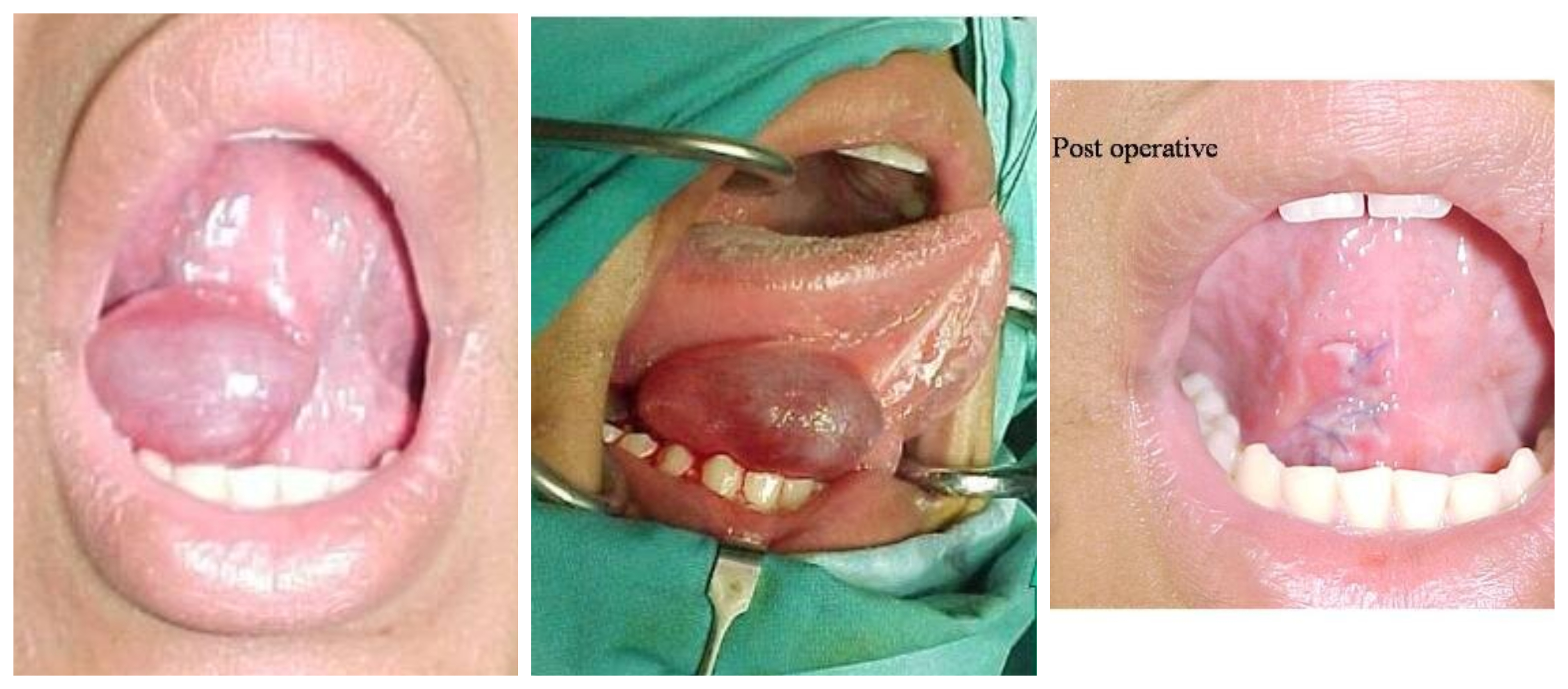 Ranula - A Cyst at Floor of Mouth