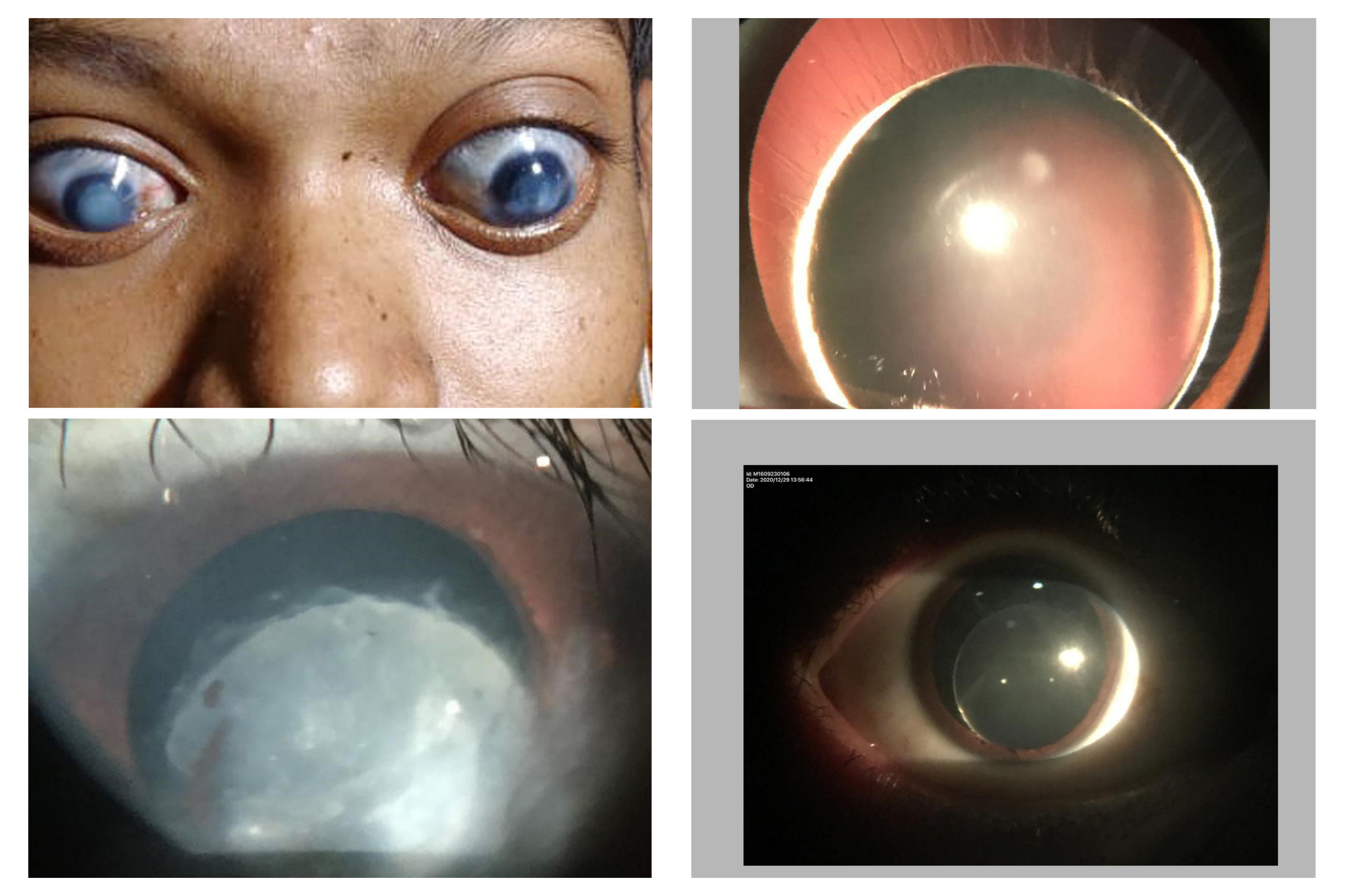 Marfan Syndrome with Complicated Microspherophakia in Family