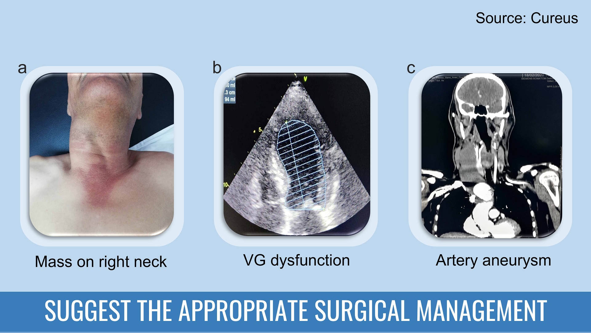 Surgical Management of a 56-year-old IAA patient