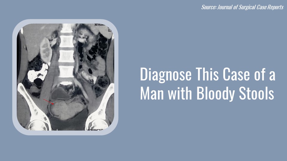 Case of a Man with Blood in His Stools