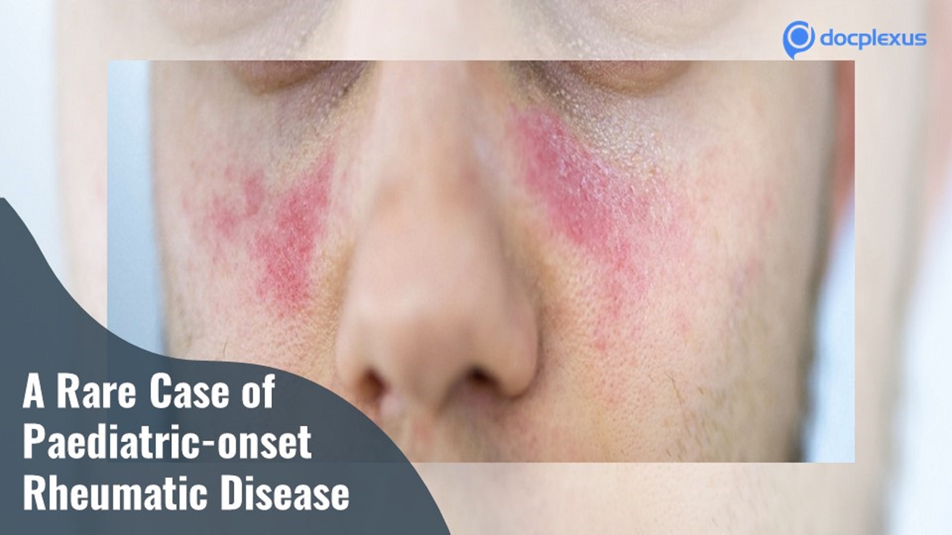 A Rare Case of Pediatric-onset Rheumatic Disease