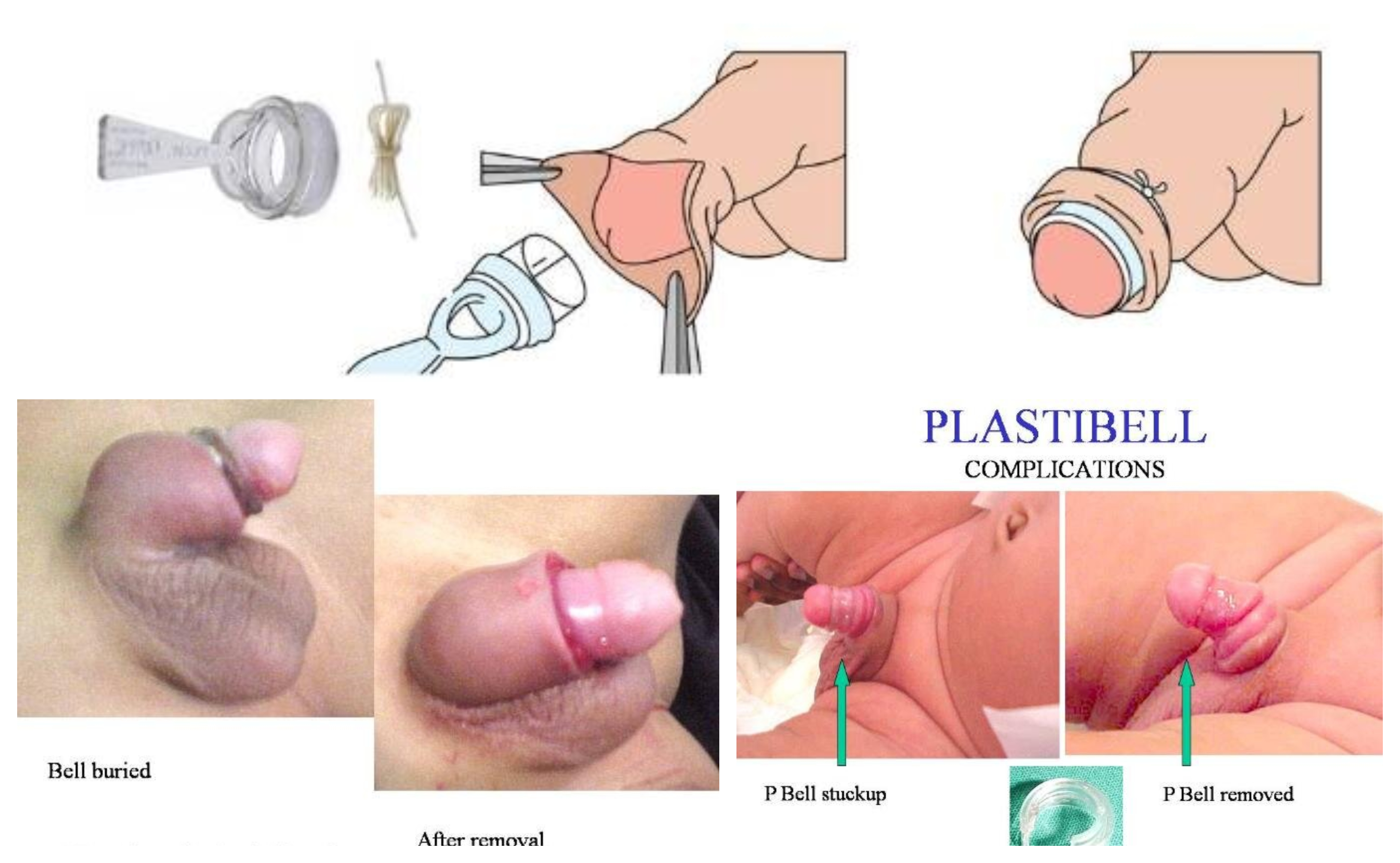Complications of Plastibell Circumcision