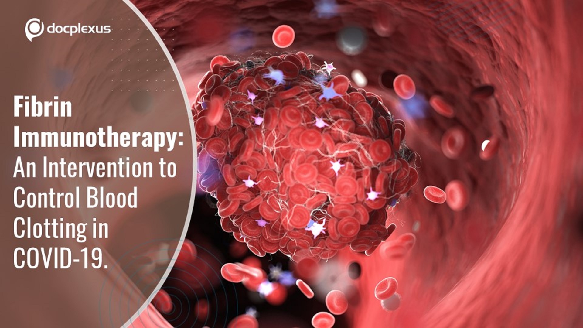Fibrin Immunotherapy: An Intervention to Control Blood Clotting in COVID-19.