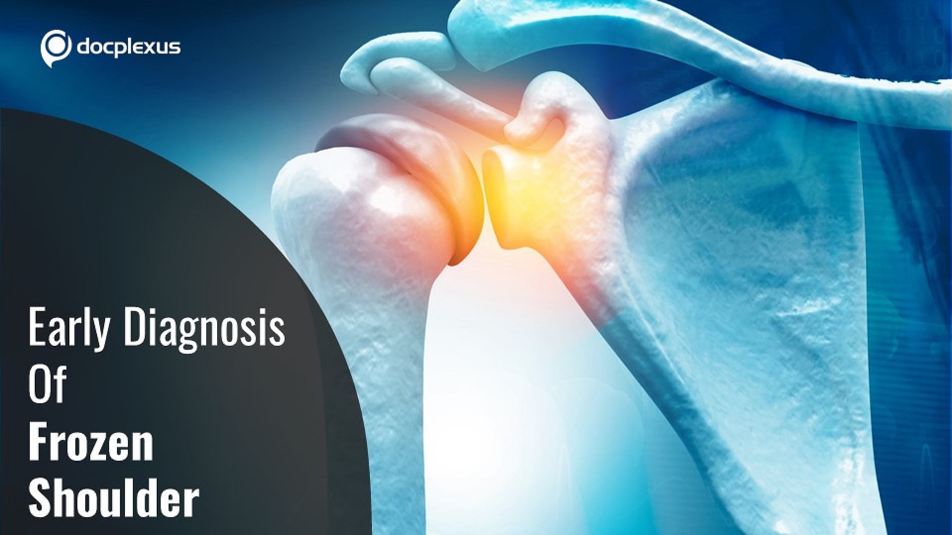 Early diagnosis is Critical for Frozen Shoulder : Experts