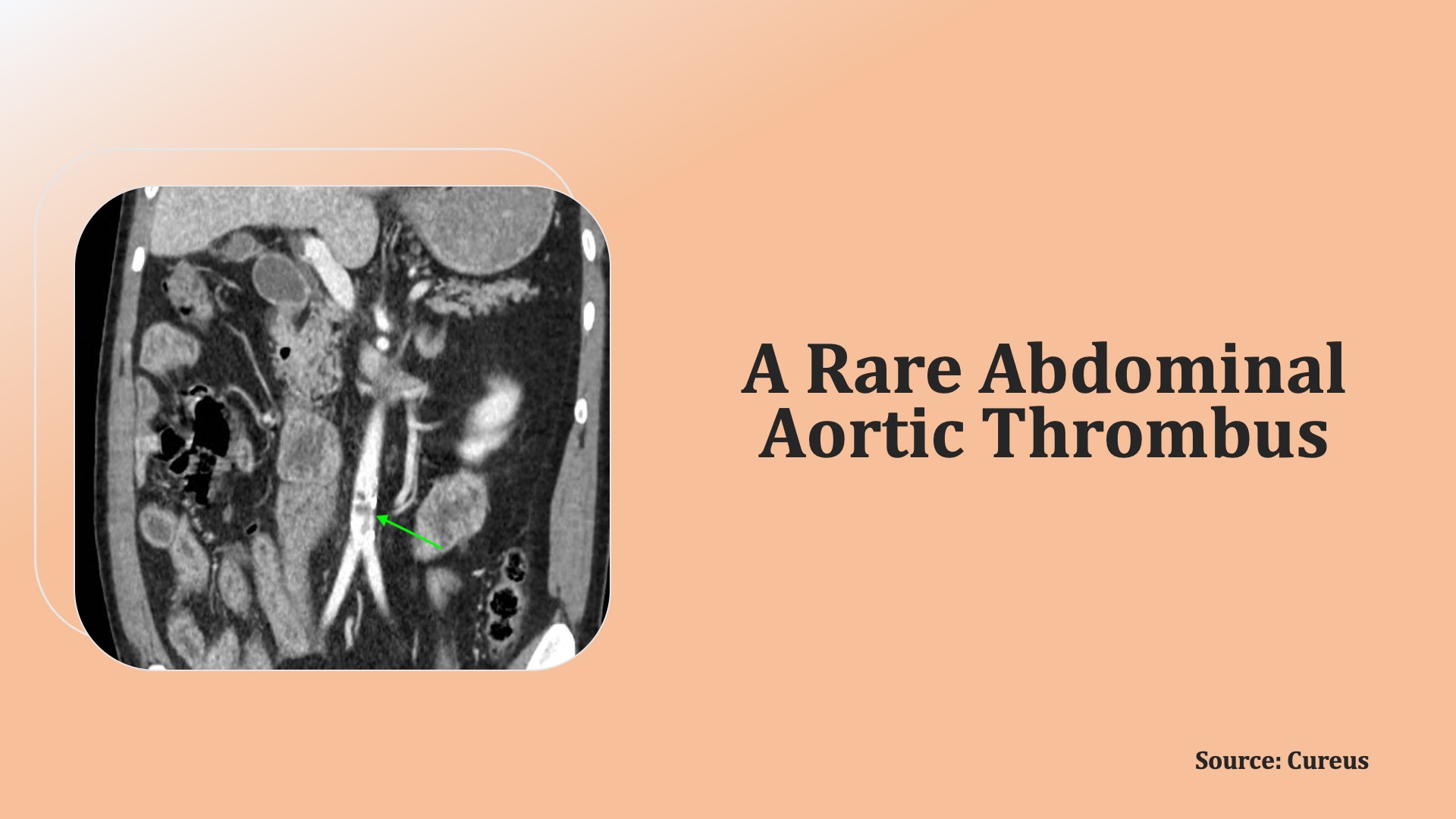 Identify the Cause of Abdominal Pain in This Patient